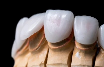 Ceramic Dental Restorations in Bellandur