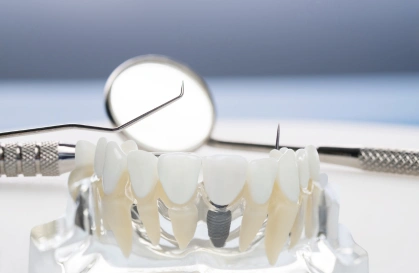 Dental Crowns in HSR Layout